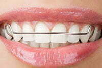 The Five Stages of an Orthodontic Treatment
