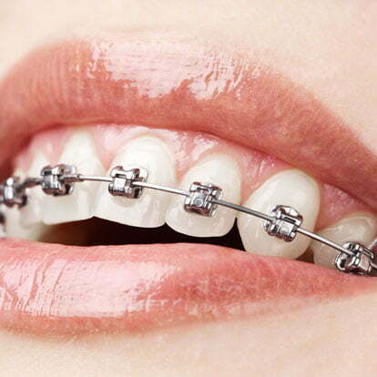 Are Metal Braces the Cheapest Braces for Kids?