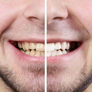 how much does tooth bonding cost; teeth bonding cost - Sky Dental Alliance