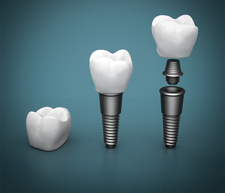implant