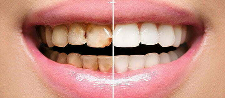 Teeth bonding